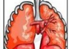 Enfermedades infiltrativas de los pulmones | Recurso educativo 76239